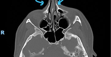 Limpeza geral nos salões nasais